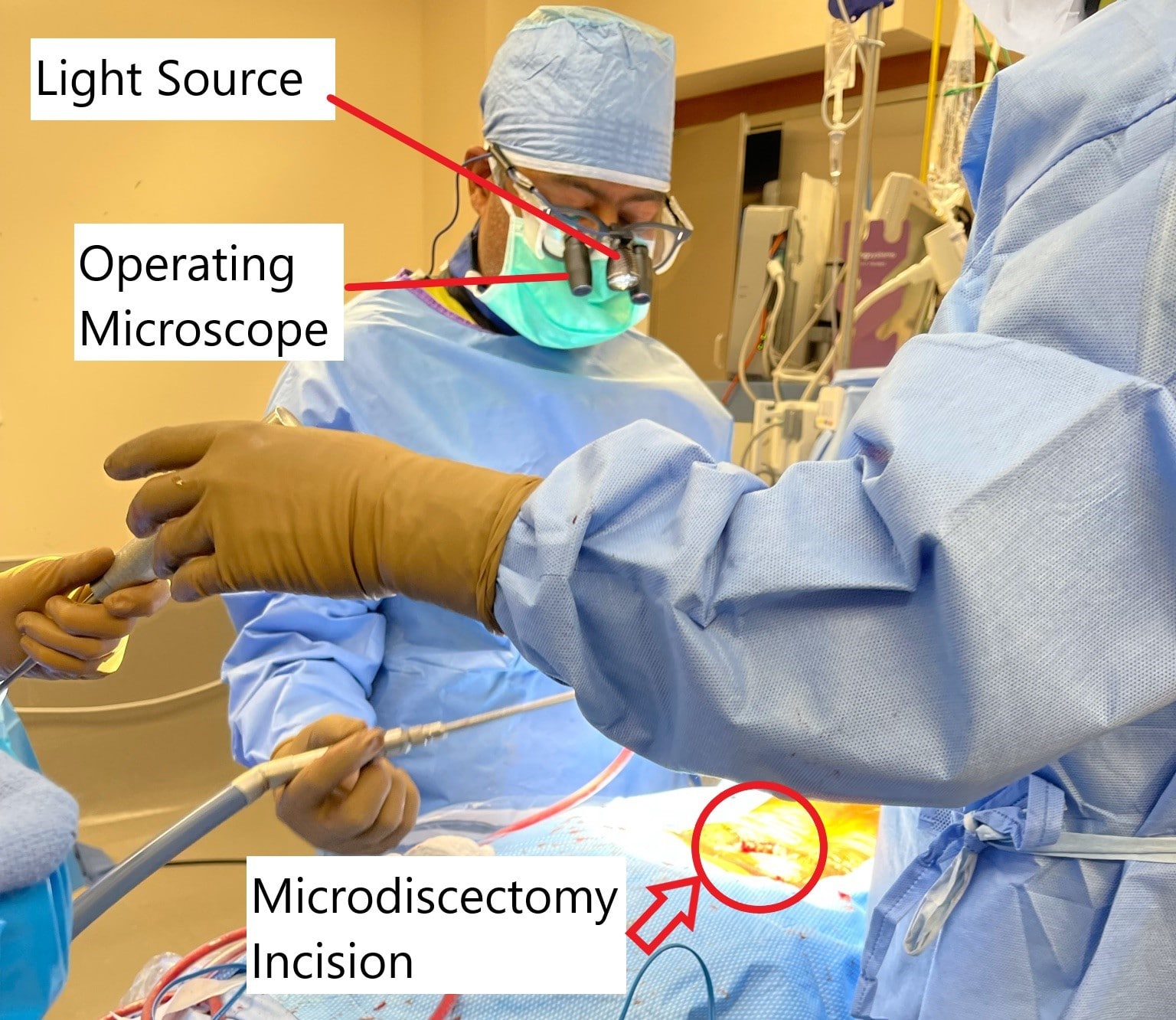 Intraoperative image showing microdiscectomy surgery. Intraoperative image showing microdiscectomy surgery.