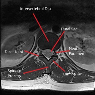 Axial section of lumbar spine MRI. Axial section of lumbar spine MRI.