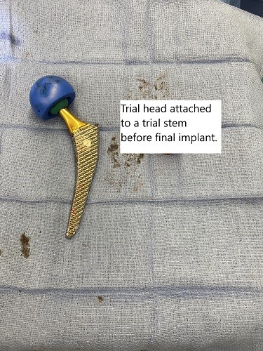 Intraoperative image of total hip replacement. Intraoperative image of total hip replacement.
