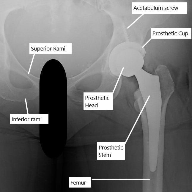 X-ray showing a total hip replacement. X-ray showing a total hip replacement.