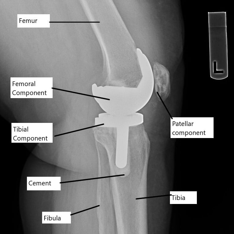 X-ray showing a total knee replacement. X-ray showing a total knee replacement.