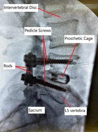 X-ray showing lumbar spine fusion at L4-L5 level. X-ray showing lumbar spine fusion at L4-L5 level.