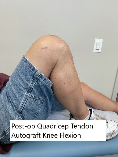 Postoperative images showing quadriceps tendon autograft scar and range of motion. Postoperative images showing quadriceps tendon autograft scar and range of motion.