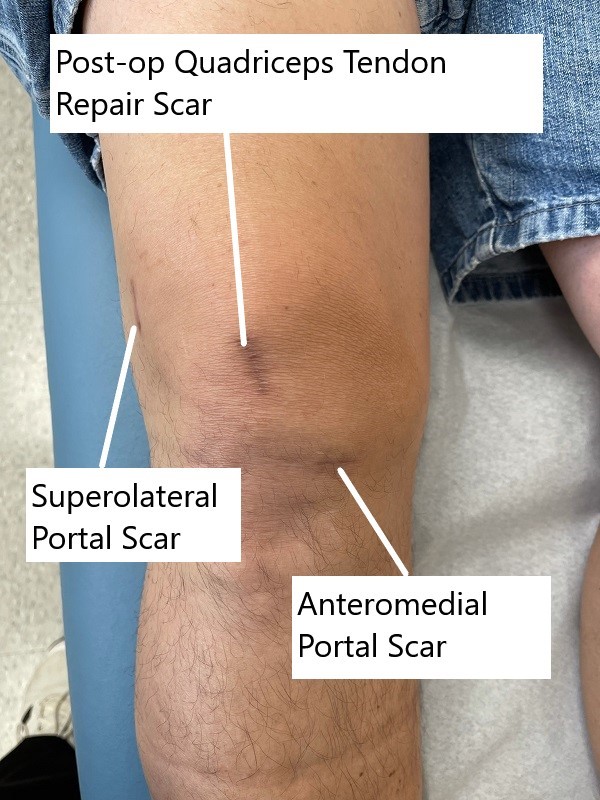 Postoperative images showing quadriceps tendon autograft scar and range of motion. Postoperative images showing quadriceps tendon autograft scar and range of motion.