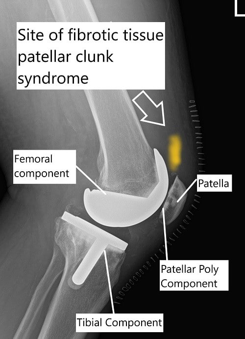 X-ray showing total knee replacement and the site of fibrous tissue in patellar clunk syndrome. X-ray showing total knee replacement and the site of fibrous tissue in patellar clunk syndrome.