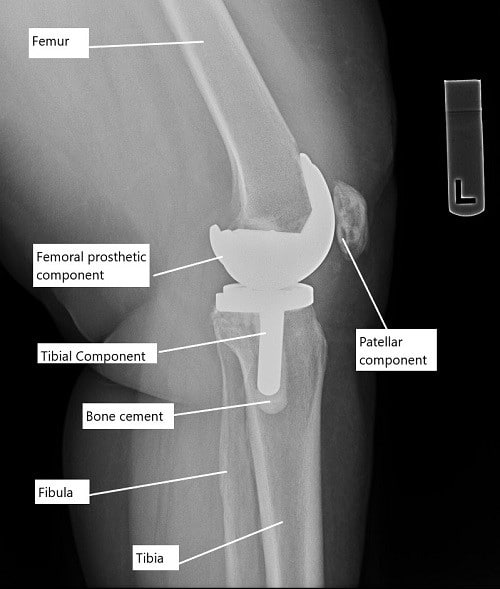 X-ray showing total knee replacement. X-ray showing total knee replacement.