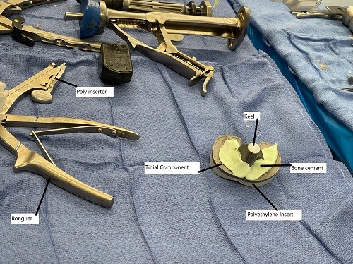 Intraoperative image showing cementing of the tibial component. Intraoperative image showing cementing of the tibial component.