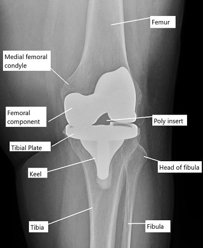 X-ray showing total knee replacement. X-ray showing total knee replacement.