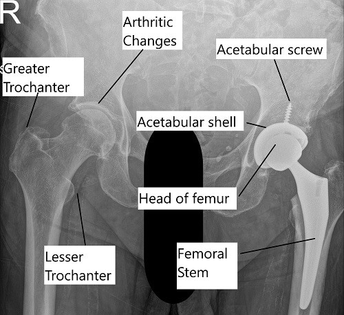X-ray showing a total hip replacement surgery. X-ray showing a total hip replacement surgery.