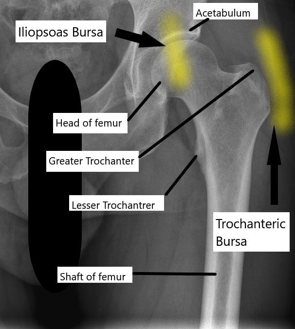 X-ray of the hip joint and its relation to the trochanteric bursa and iliopsoas bursa. X-ray of the hip joint and its relation to the trochanteric bursa and iliopsoas bursa.