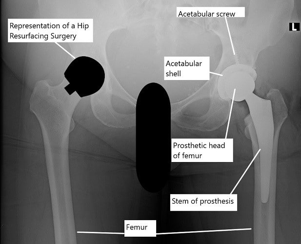 X-ray showing a total hip replacement on the left hip and an illustration of hip resurfacing on the right hip. X-ray showing a total hip replacement on the left hip and an illustration of hip resurfacing on the right hip.