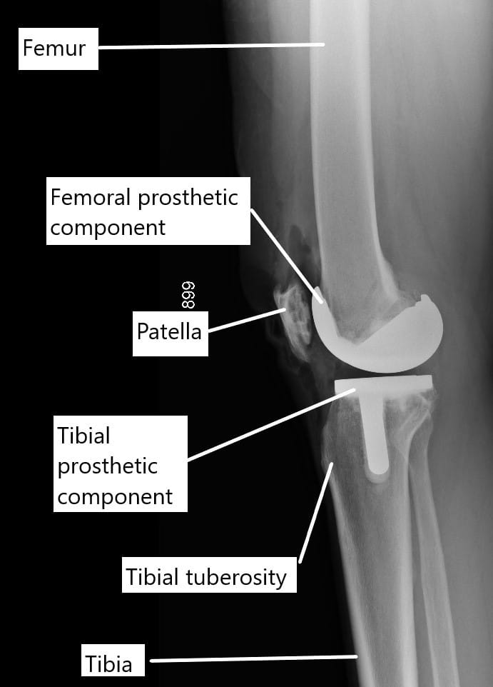 X-ray showing a total knee replacement. X-ray showing a total knee replacement.
