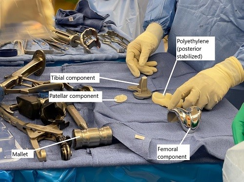 Intraoperative image showing prosthetic component. Intraoperative image showing prosthetic component.