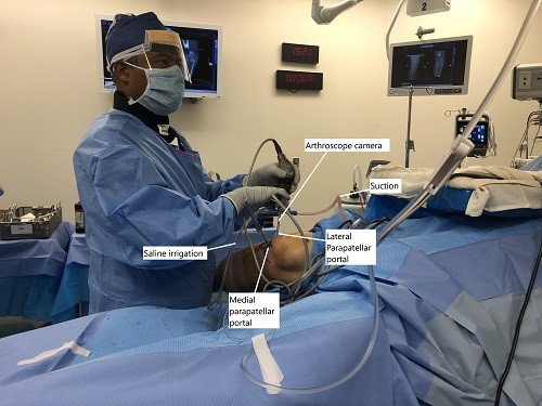 Imagen intraoperatoria que muestra la reparación artroscópica de MPFL. Imagen intraoperatoria que muestra la reparación artroscópica de MPFL.