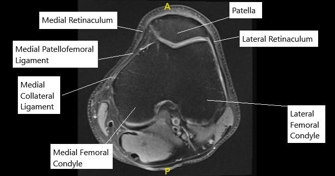 MRI of the knee in axial section showing normal MPFL. MRI of the knee in axial section showing normal MPFL.