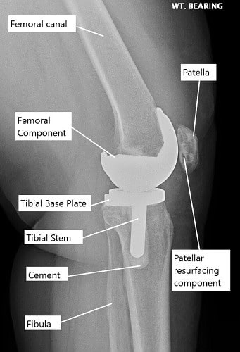 X-ray showing a total knee replacement. X-ray showing a total knee replacement.