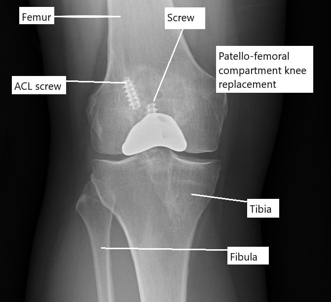 X-ray showing a partial knee replacement. X-ray showing a partial knee replacement.
