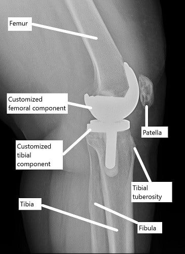 X-ray showing a custom knee replacement. X-ray showing a custom knee replacement.