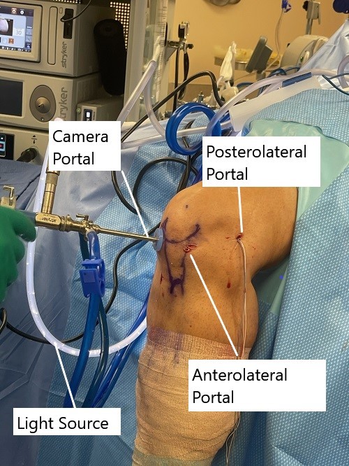 Intraoperative image showing knee arthroscopic ACL reconstruction. Intraoperative image showing knee arthroscopic ACL reconstruction.