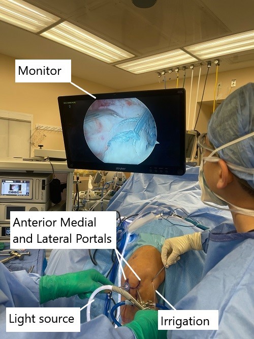 Intraoperative image showing ACL reconstruction. Intraoperative image showing ACL reconstruction.