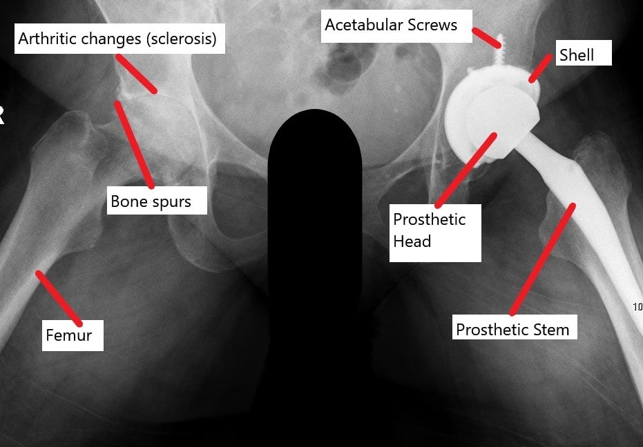 Radiografía que muestra una prótesis total de cadera con una articulación artrósica contralateral.