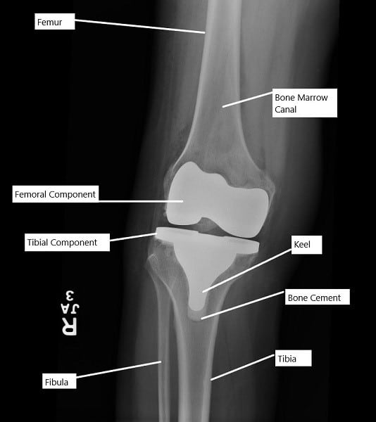 X-ray showing a total knee replacement. X-ray showing a total knee replacement.