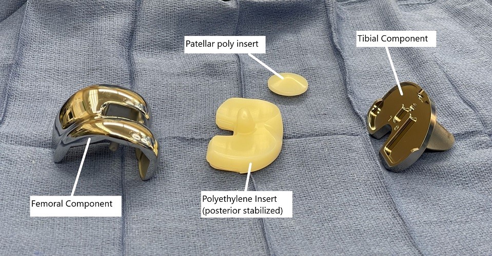 Intraoperative image showing knee replacement implants. Intraoperative image showing knee replacement implants.