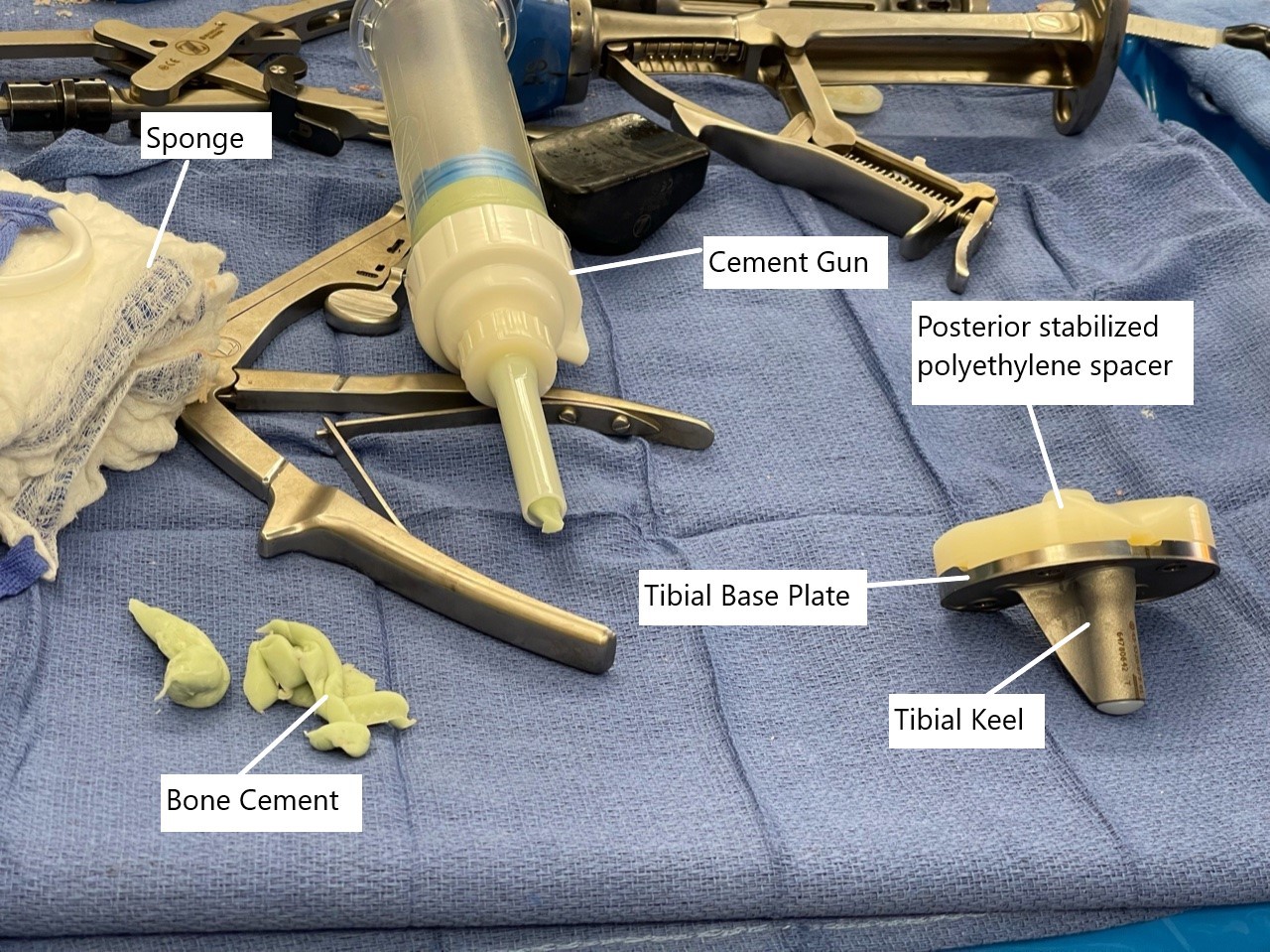 Intraoperative image showing the tibial component with polyethylene spacer. Intraoperative image showing the tibial component with polyethylene spacer.