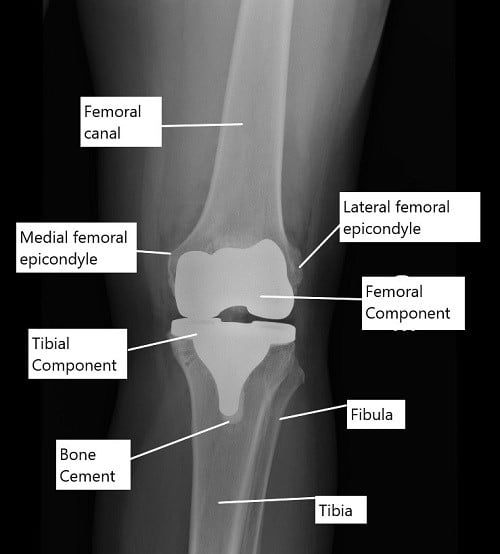 X-ray showing a total knee replacement in AP view. X-ray showing a total knee replacement in AP view.