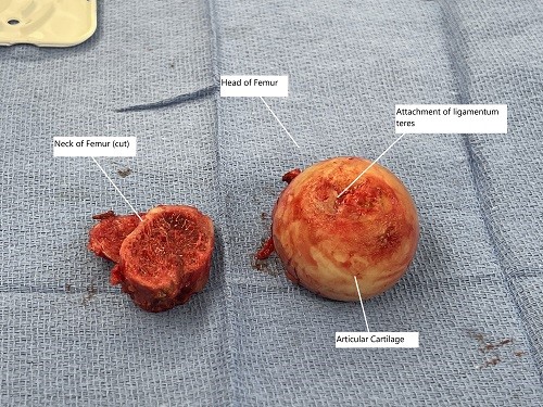 Intraoperative image showing the removed head of the femur and the neck of the femur. Intraoperative image showing the removed head of the femur and the neck of the femur.