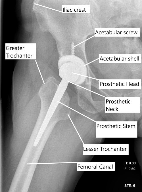X-ray showing a lateral view of a total hip replacement. X-ray showing a lateral view of a total hip replacement.