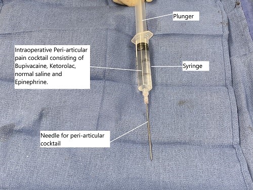 Intraoperative cocktail for peri-articular injection used for pain control after the surgery. Intraoperative cocktail for peri-articular injection used for pain control after the surgery.