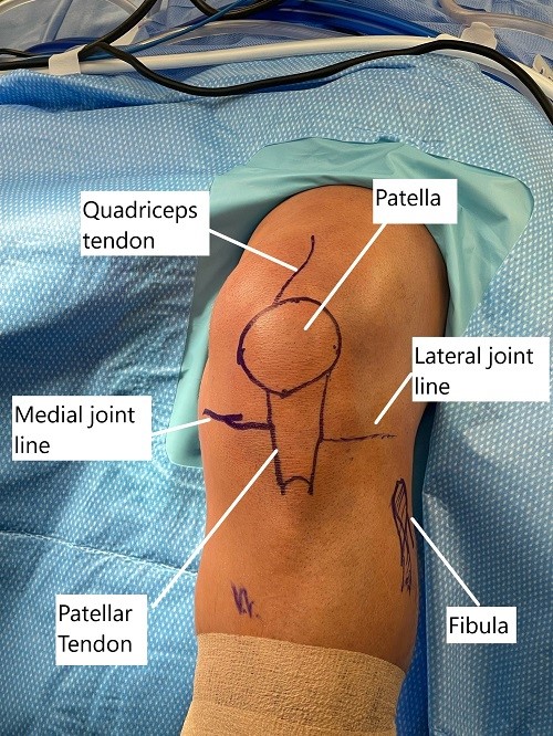 Intraoperative skin markings of the knee joint before arthroscopic reconstruction. Intraoperative skin markings of the knee joint before arthroscopic reconstruction.
