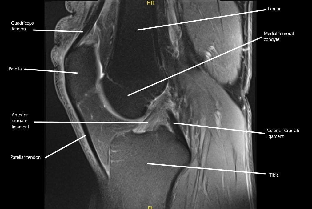MRI showing the normal cruciate ligaments in the knee joint in the sagittal section. MRI showing the normal cruciate ligaments in the knee joint in the sagittal section.