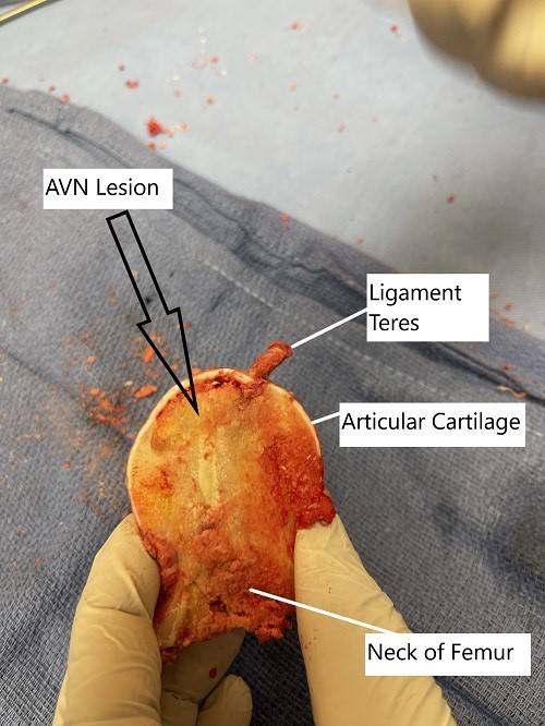 Removed head of femur during surgery showing avascular necrotic lesion. Removed head of femur during surgery showing avascular necrotic lesion.