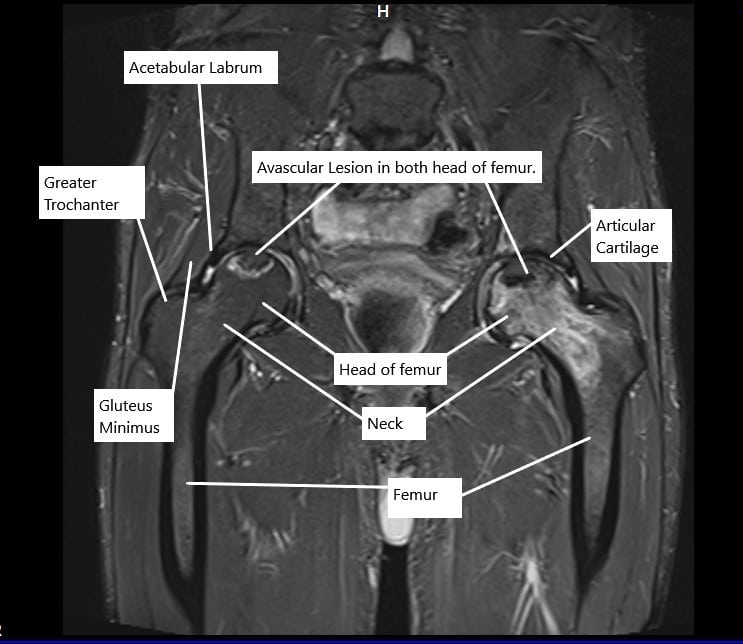 MRI in the coronal section showing avascular necrosis lesions in both hips. MRI in the coronal section showing avascular necrosis lesions in both hips.