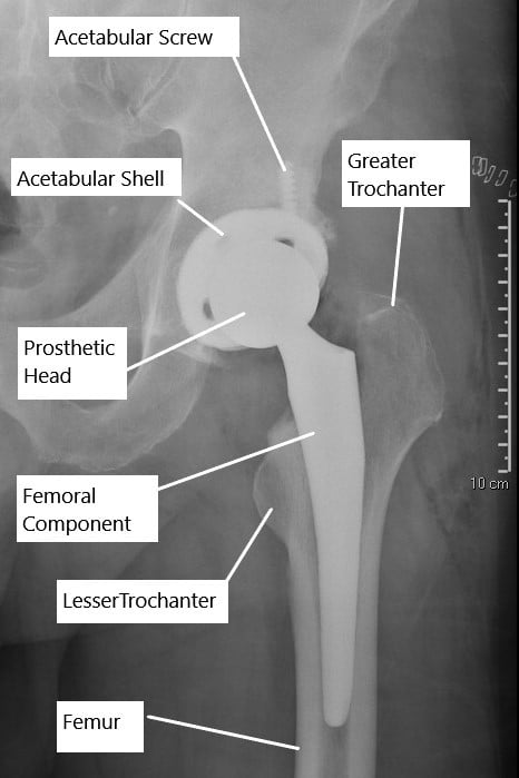 X-ray showing an uncemented total hip replacement. X-ray showing an uncemented total hip replacement.