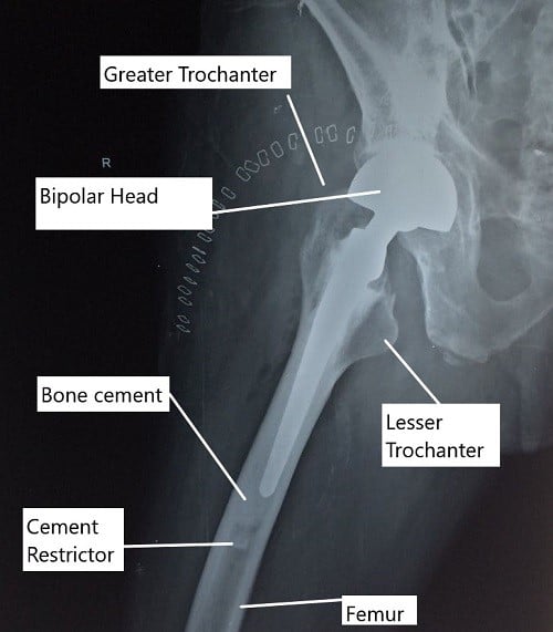 X-ray of the hip in lateral view showing a partial cemented hip replacement. X-ray of the hip in lateral view showing a partial cemented hip replacement.