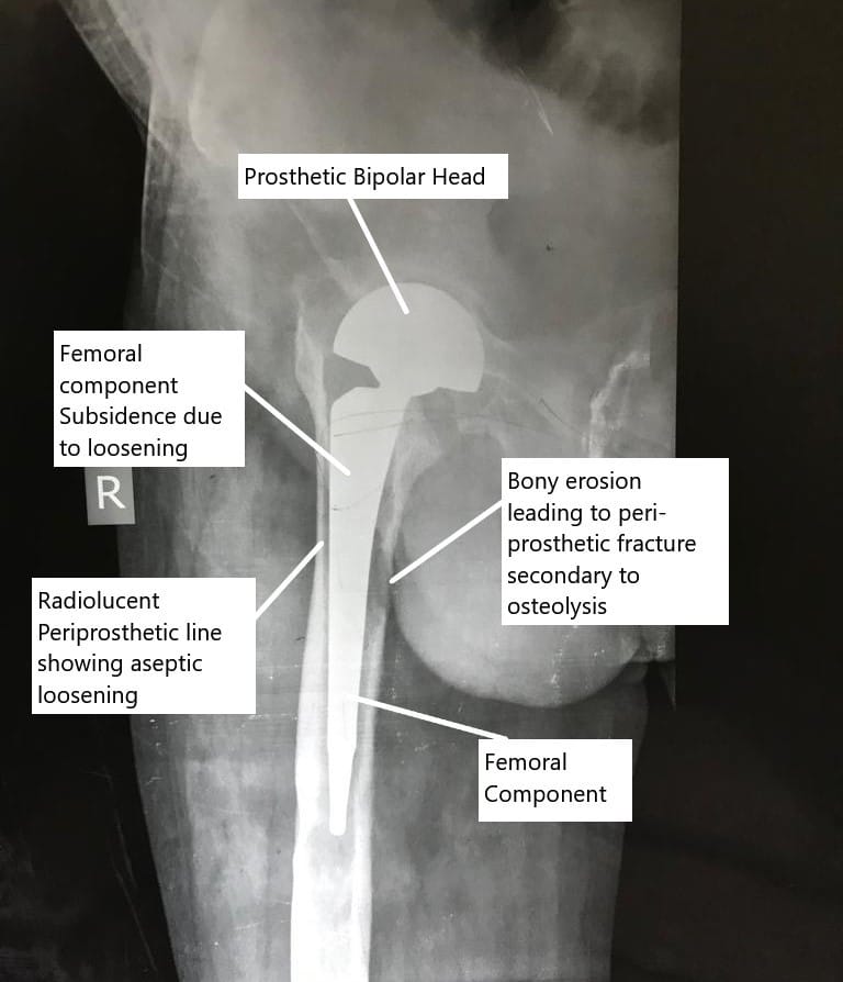 X-ray showing aseptic loosening of the hip replacement. X-ray showing aseptic loosening of the hip replacement.