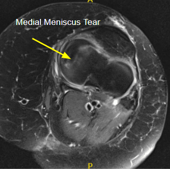 La resonancia magnética de la rodilla izquierda sugirió desgarro radial del menisco medial y esguince/desgarro del ligamento colateral medial.
