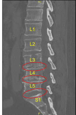Disc bulge and facet arthropathy