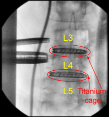 Postoperative X-ray