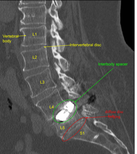 Laminectomy and Fusion sample 