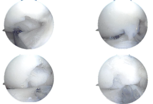Arthroscopic view tear of the lateral meniscus posterior horn