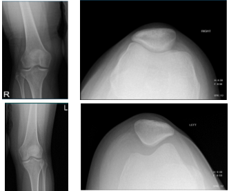 Knee X-ray complete with patella