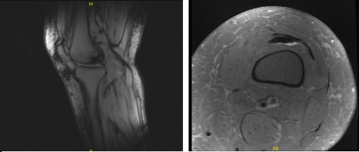 MRI-3T Left Knee Non-contrast