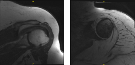 MRI-3T Left Shoulder Non-contrast