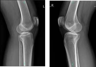 X-ray Bilateral Knees 3 views each