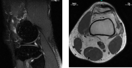MRI Left Knee Non-contrast