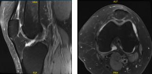 MRI-3 Left knee non-contrast
